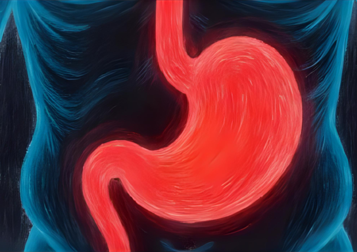 Gastric Ulcers