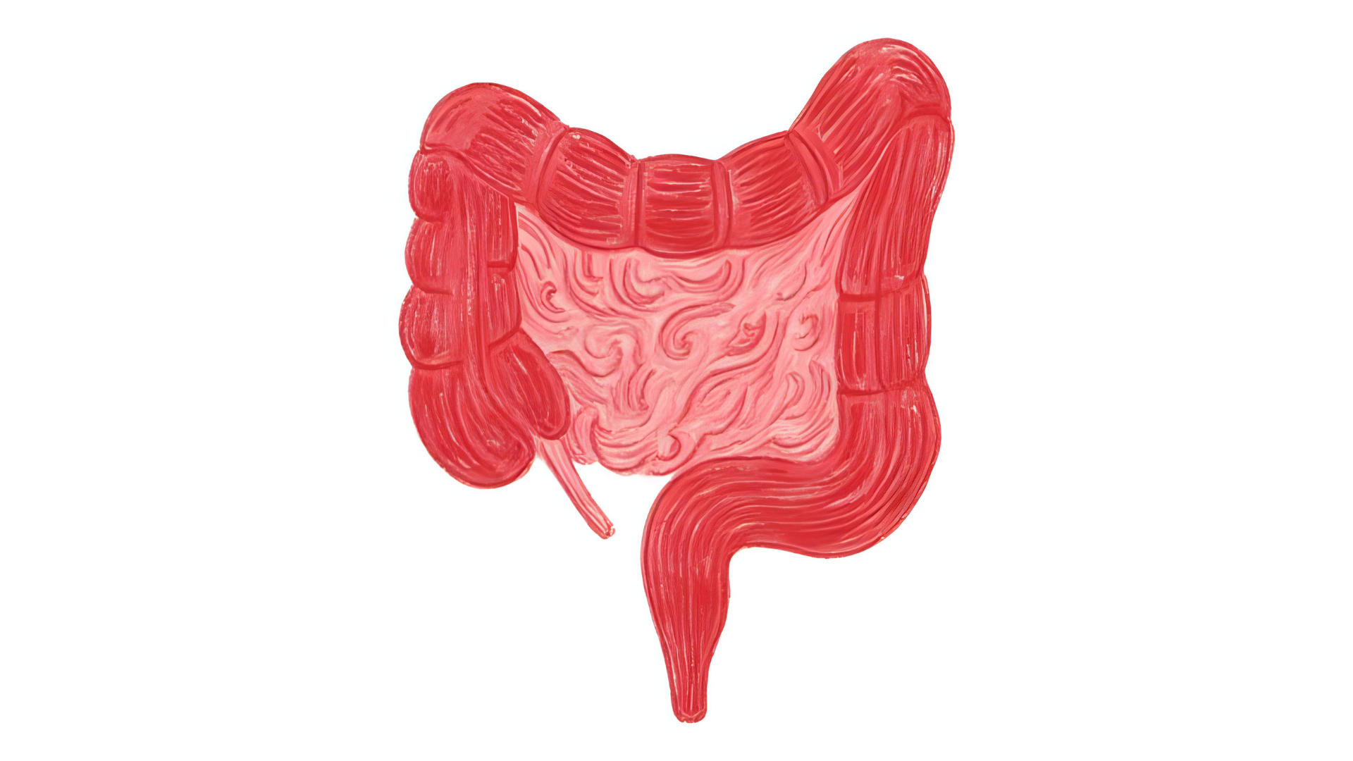 colon cancer